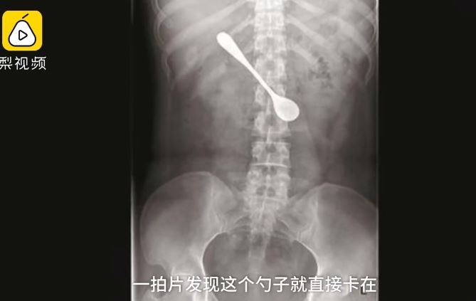 鱼刺卡喉咙！天兵女自行猛挖　下一秒“13cm铁汤匙吞下肚“